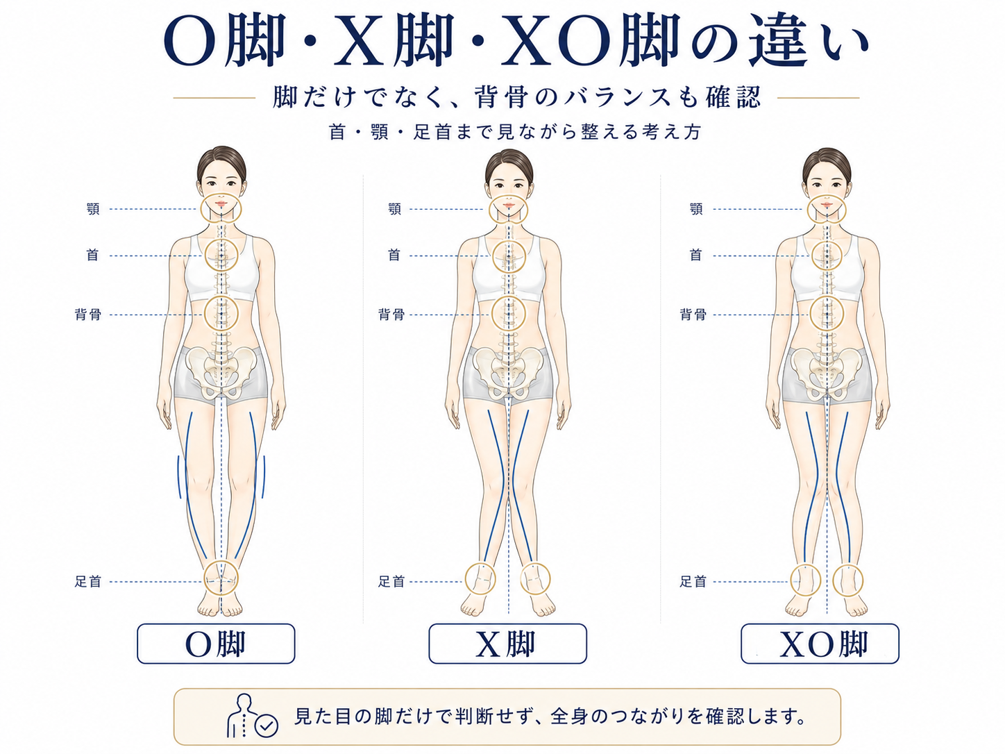 O脚・X脚・XO脚の違いを示したイラスト