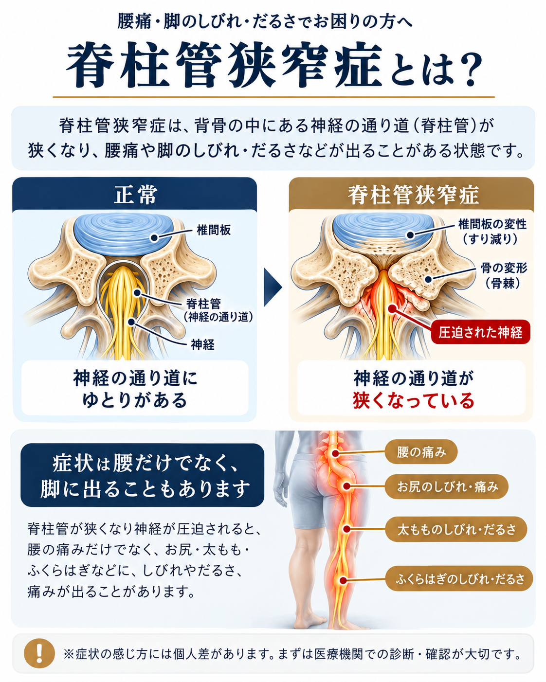 正常な脊柱管と脊柱管狭窄症の違い、腰や脚に出る症状を説明した図