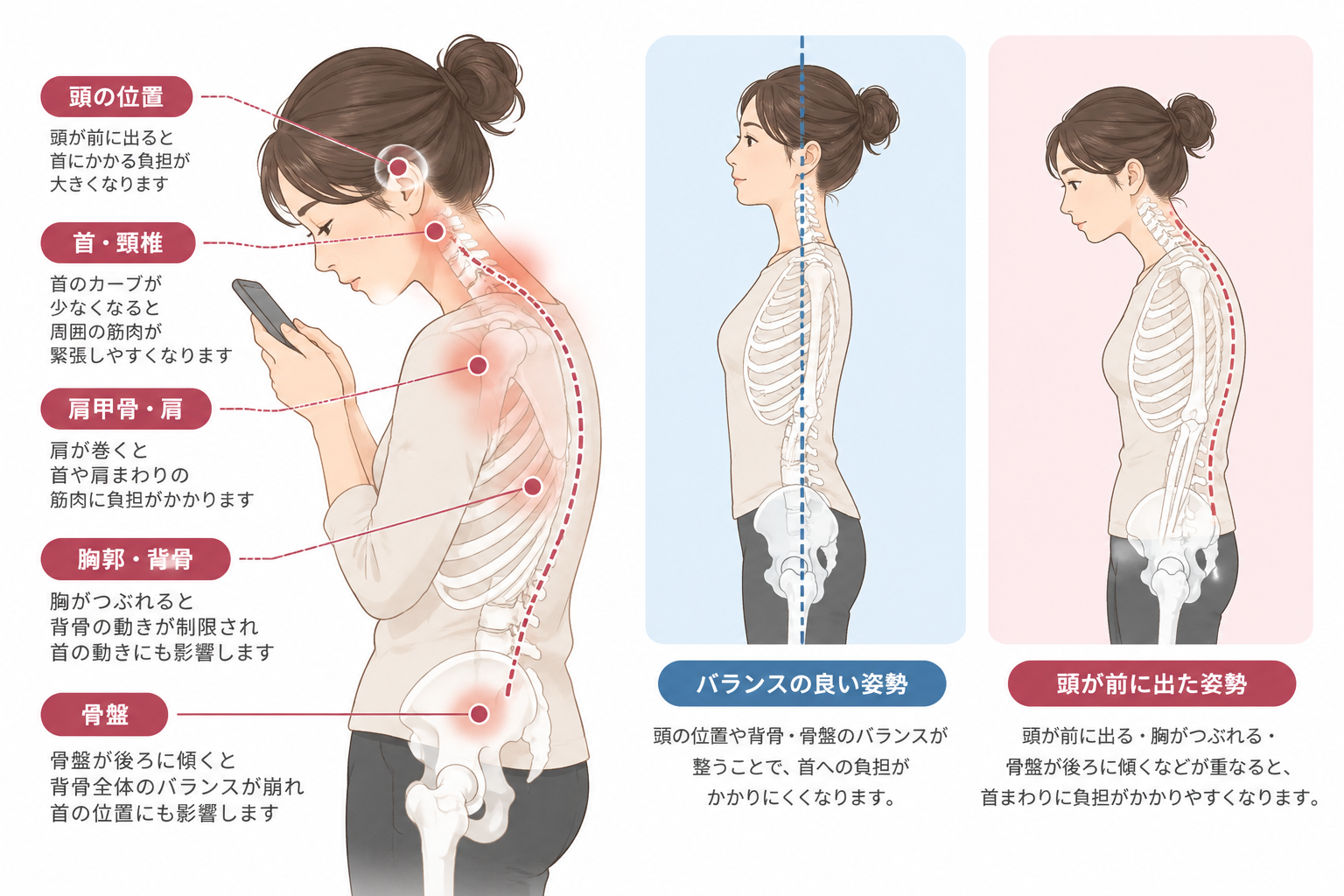 頭の位置、頸椎、肩甲骨、胸郭、骨盤など身体のつながりと首への負担を説明した図