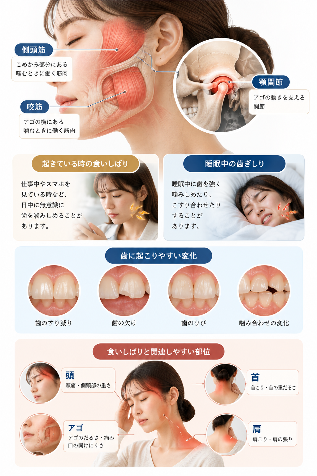 食いしばり・歯ぎしりについて、側頭筋・咬筋・顎関節、日中と睡眠中の噛みしめ、歯への負担、頭・アゴ・首・肩との関係を説明した図
